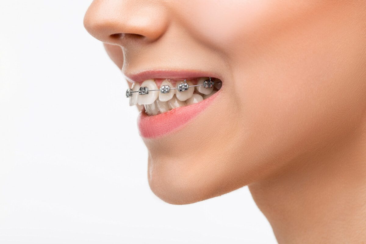Qué no se puede comer con brackets