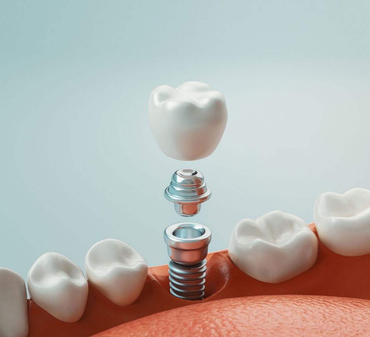 Nueva Técnica de cirugía dental en Vigo