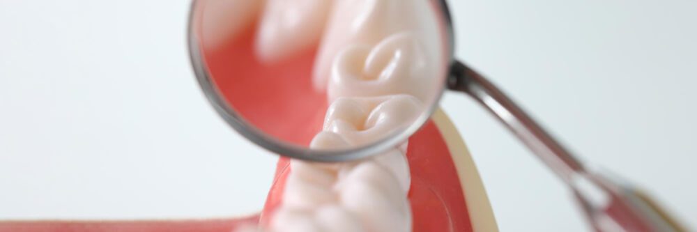 ¿Qué es una endodoncia?