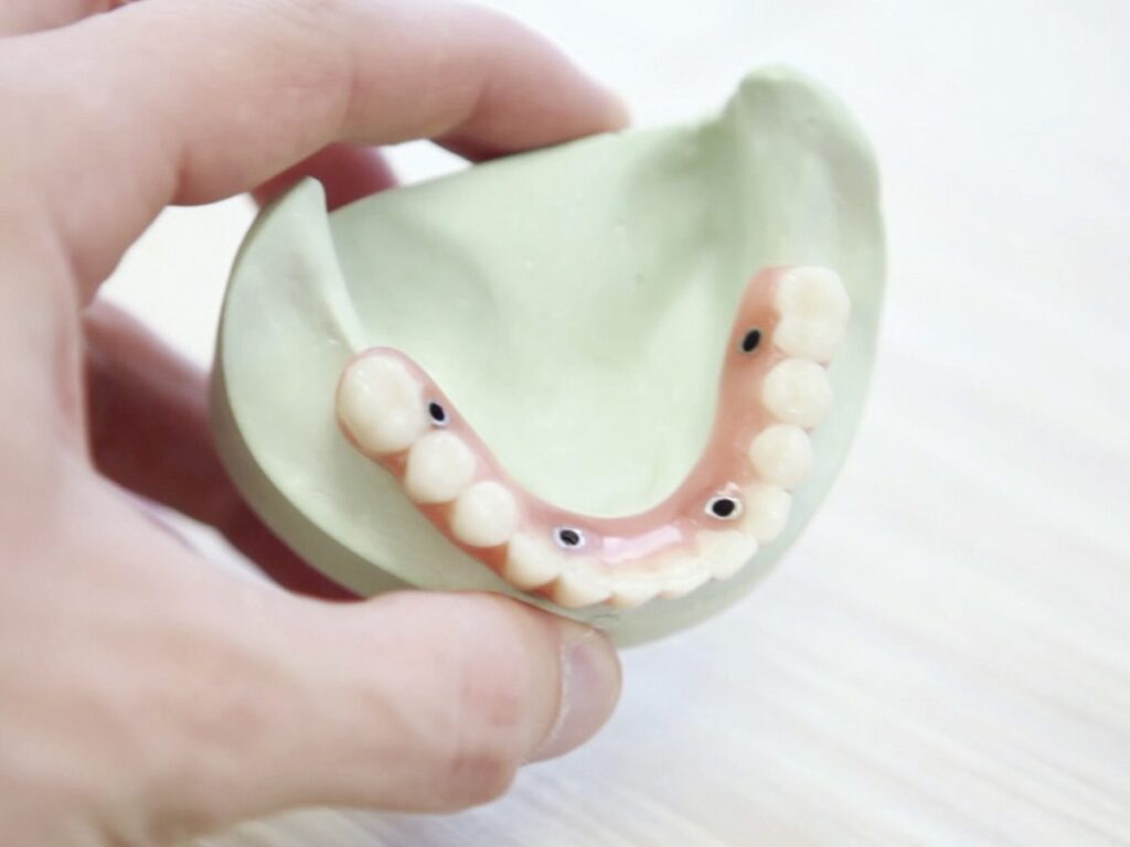 Ventajas de los implantes de carga inmediata