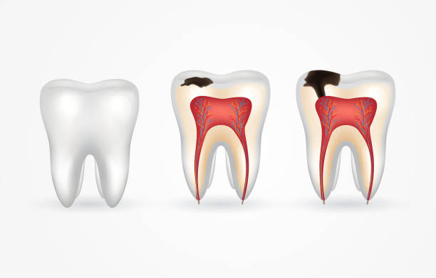 Por qué aparecen las caries: causas principales